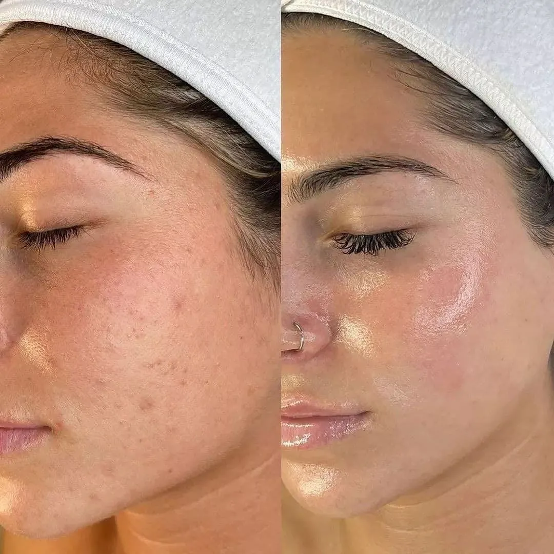 HydraFacial Results